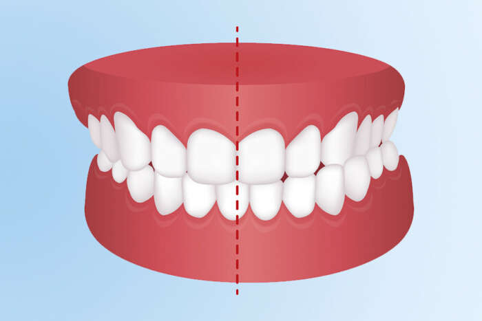 Maloclusi N Dental Qu Es Y C Mo Corregirla