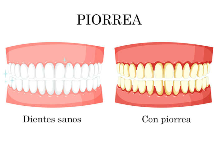 Piorrea Cuáles son sus síntomas y tratamientos