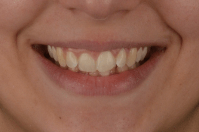 Caso de apiñamiento dental