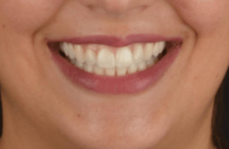 Después de ortodoncia y blanqueamiento dental