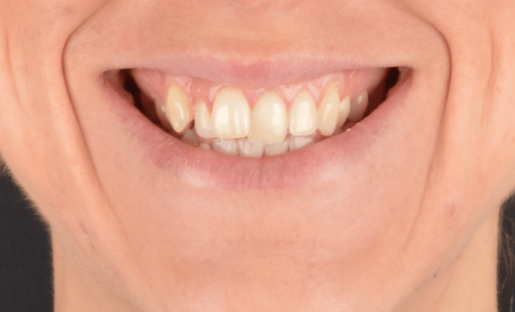 Caso de sonrisa gingival y maxilar hipoplásico