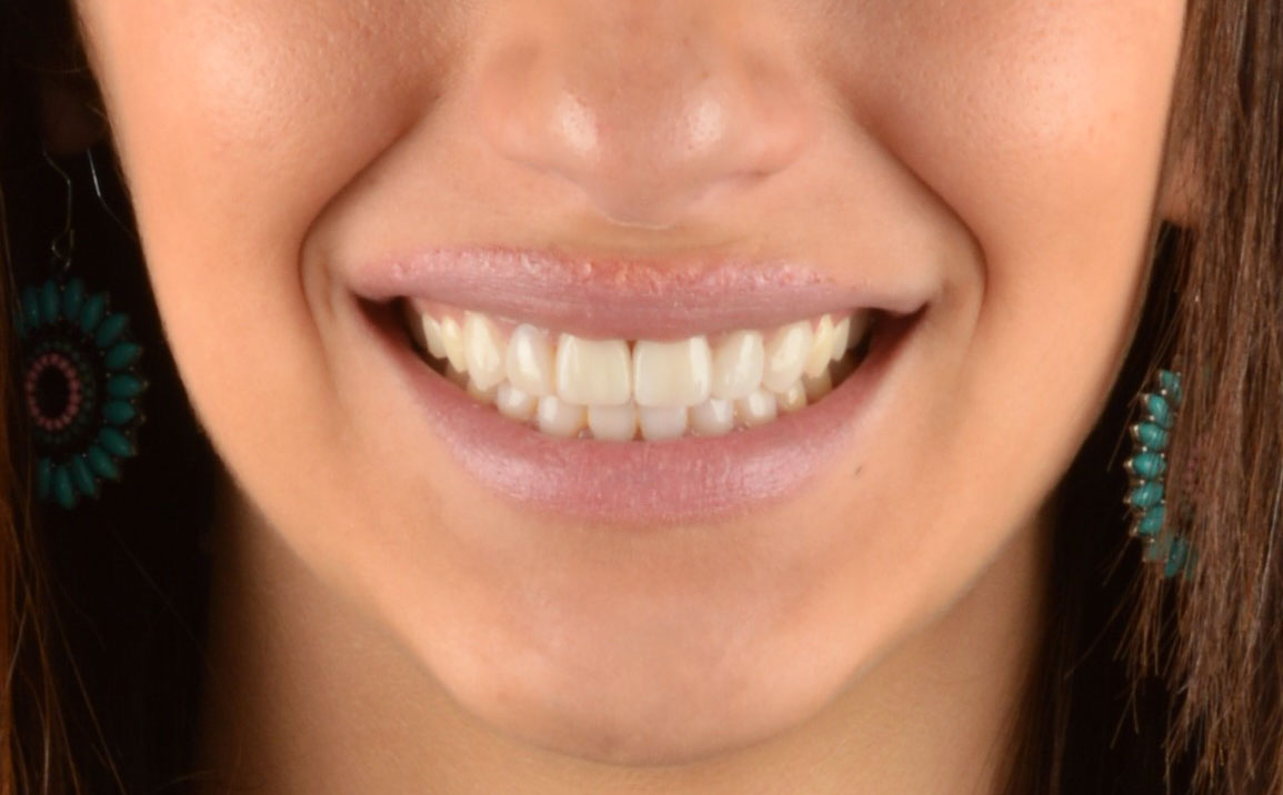 Después de una ortodoncia con corticotomías, cirugía periodontal y carillas dentales de composite