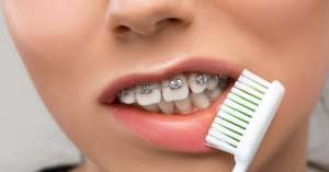 ¿Cómo hay que cepillarse los dientes con brackets? Trucos y consejos profesionales