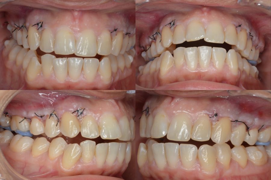 Tratamiento de corticotomías para ortodoncia