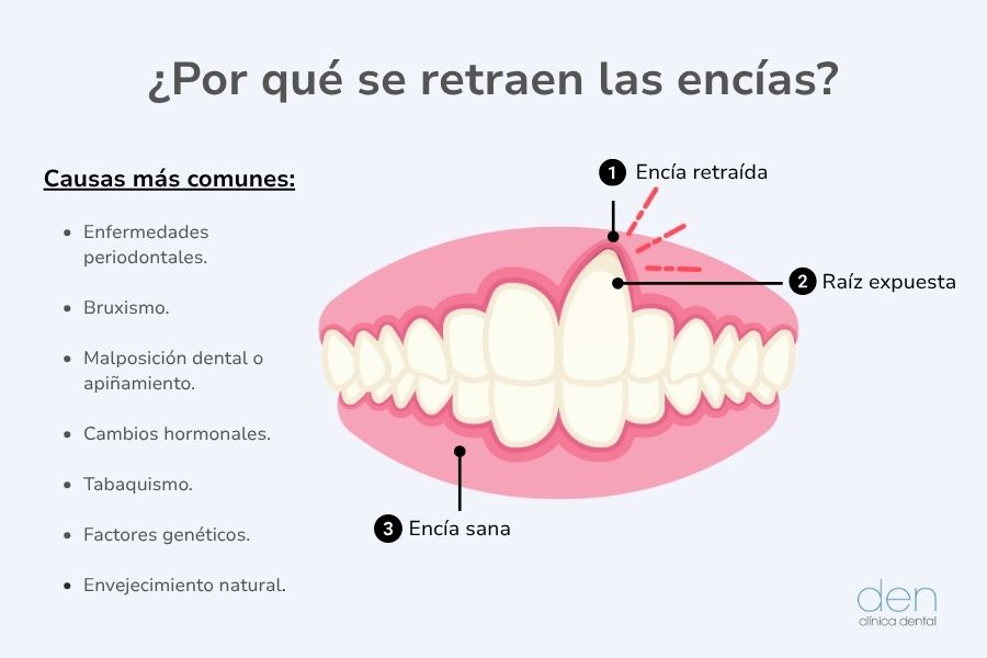 Por qué se retraen las encías