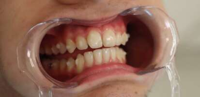 ¿Qué son los ataches dentales, para qué sirven y cuándo se usan en ortodoncia?