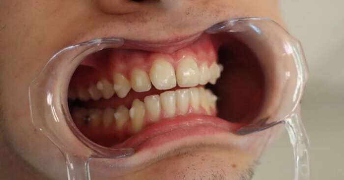 ataches dentales en ortodoncia invisible