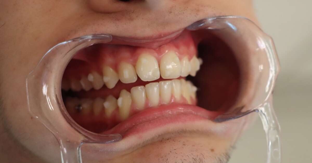 Clínicas Den - ¿Qué son los ataches dentales, para qué sirven y cuándo se usan en ortodoncia?