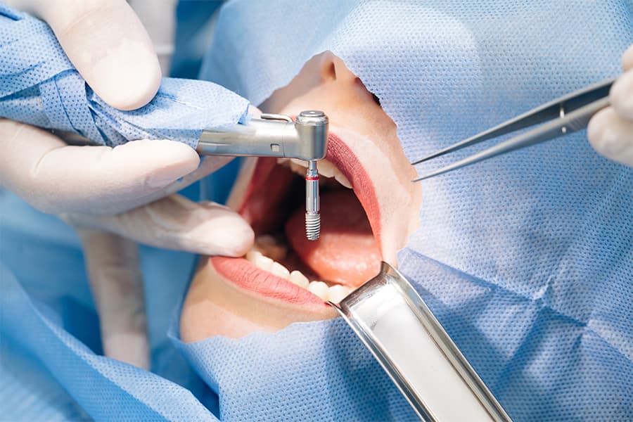 Cómo se ponen los implantes dentales