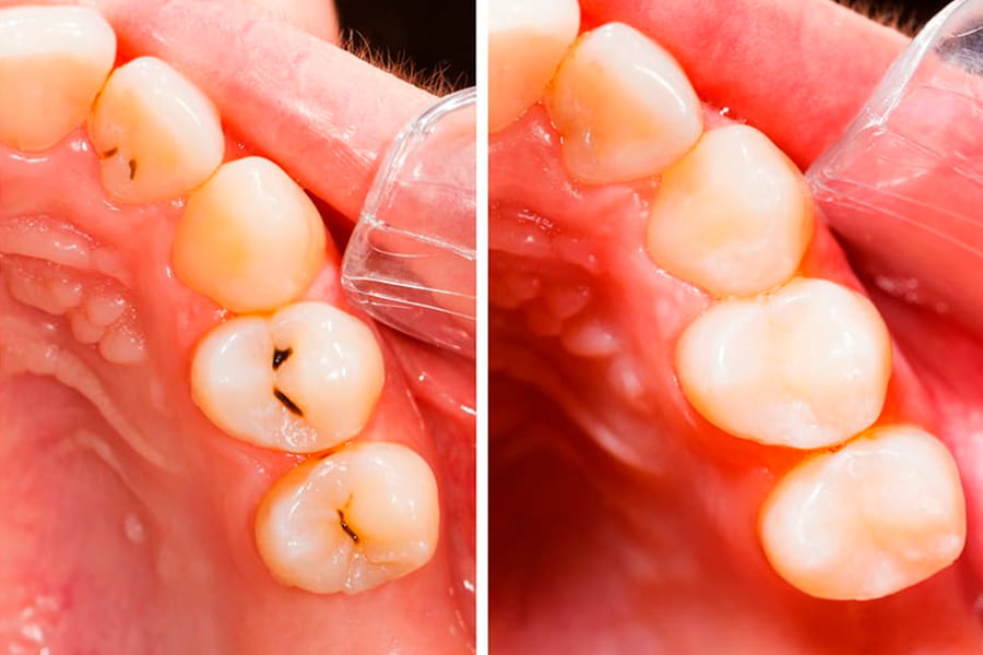empaste dental antes y después