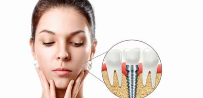 ¿Qué son implantes dentales, para qué sirven y cómo se colocan?
