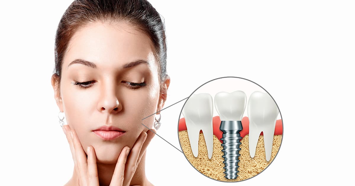 Clínicas Den - ¿Qué son implantes dentales, para qué sirven y cómo se colocan?