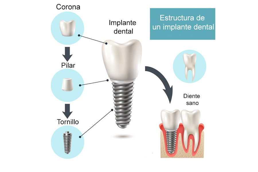 partes implante dental