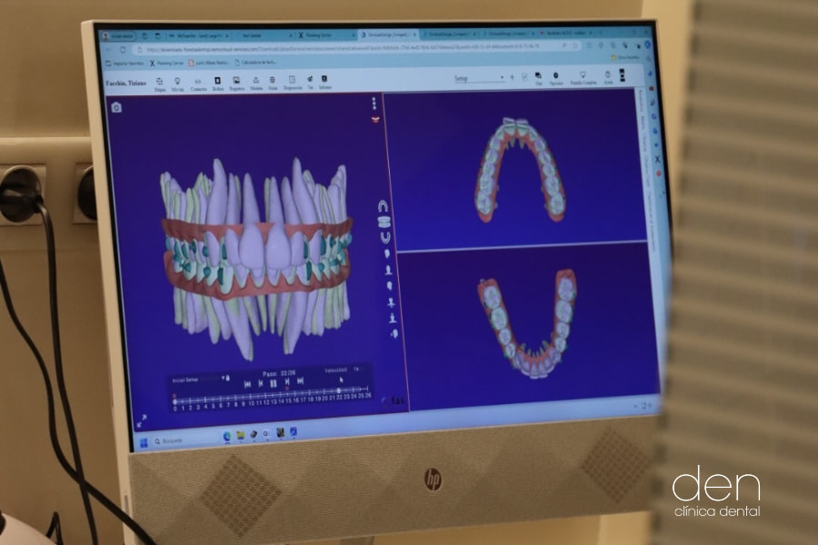 Tecnología dental para ataches dentales en ortodoncia
