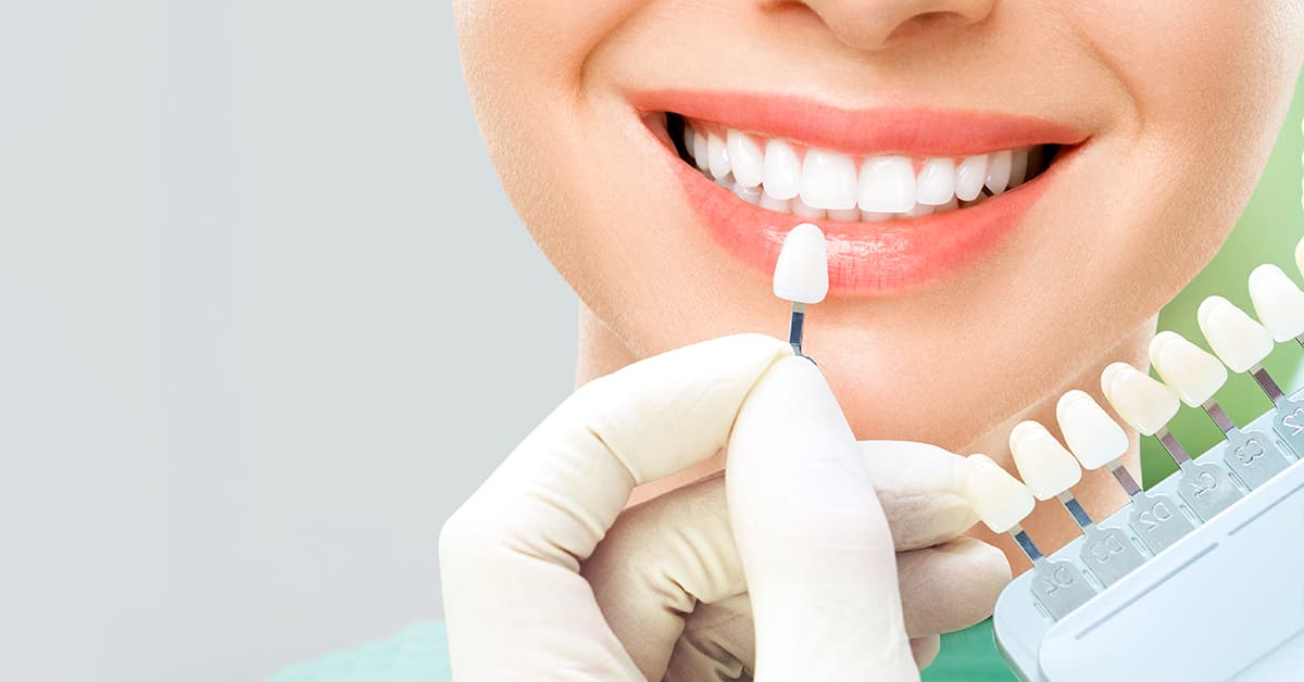 Clínicas Den - ¿Qué son las carillas dentales, para qué sirven y cómo se ponen?