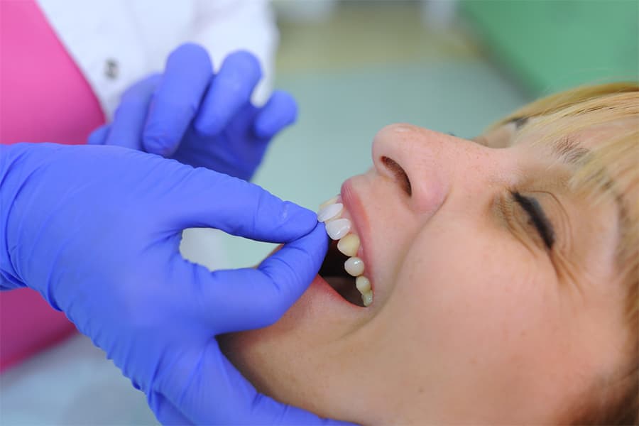 Colocación de carillas dentales