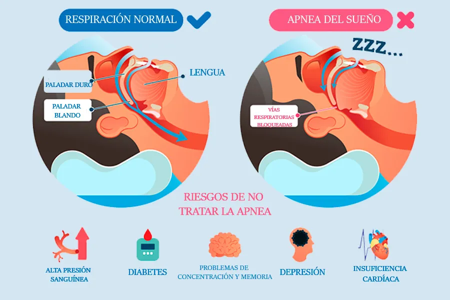 Apnea del Sueño en Zaragoza: Sintomas y tratamiento Apnea del sueño