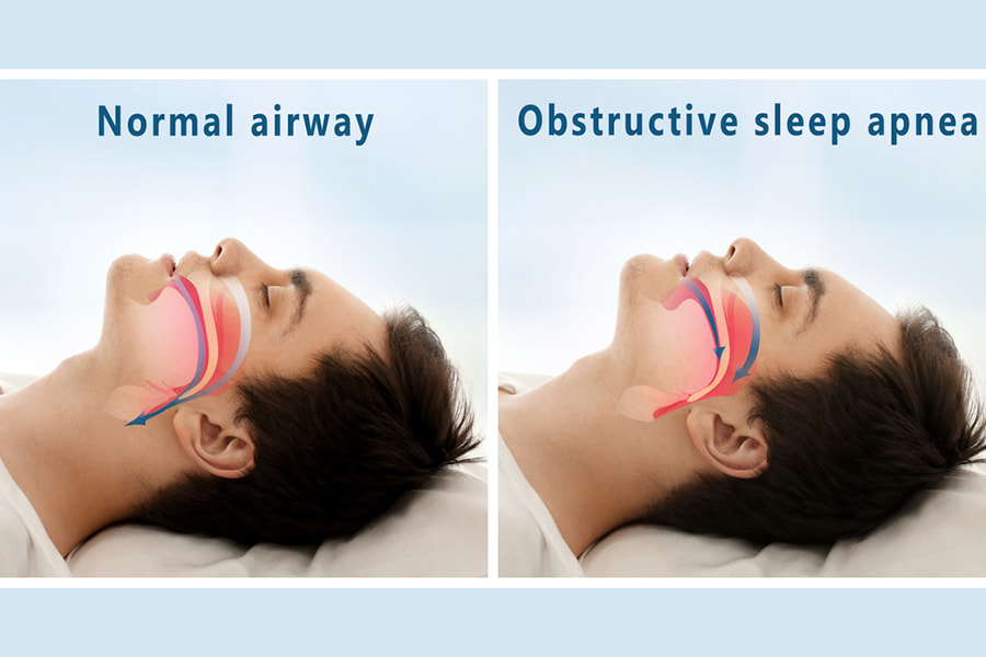 Tipos de apnea del sueño