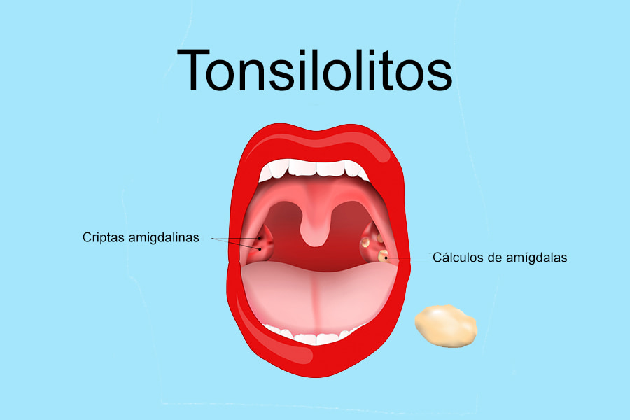 Qué son los tonsilolitos