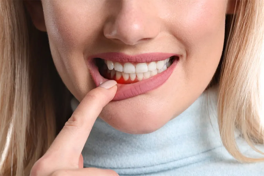 Cómo saber si tengo gingivitis y periodontitis? - Clínica Blasi