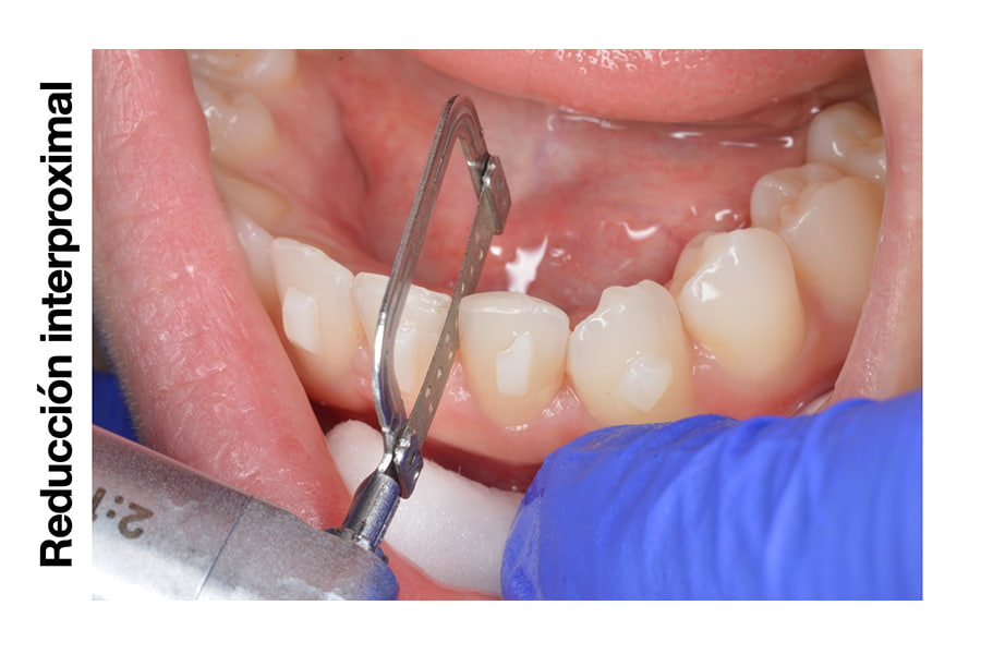 IPR en ortodoncia: Reducción interproximal