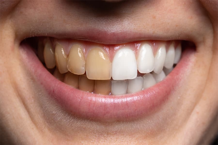 Qué son las manchas blancas en los dientes
