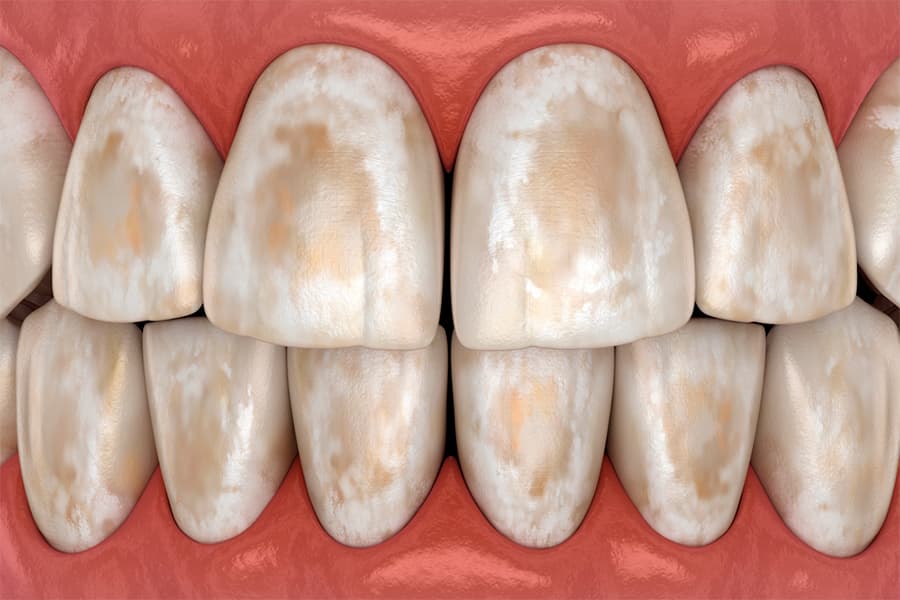 Desmineralización dental