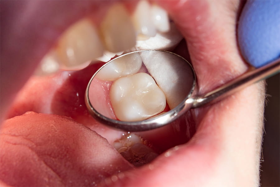 Qué significa obturación dental