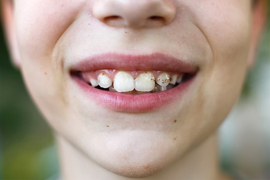 Qué son las manchas en los dientes