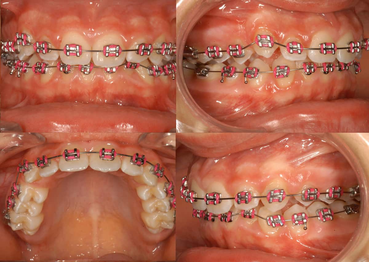 Brackets en las dos arcadas