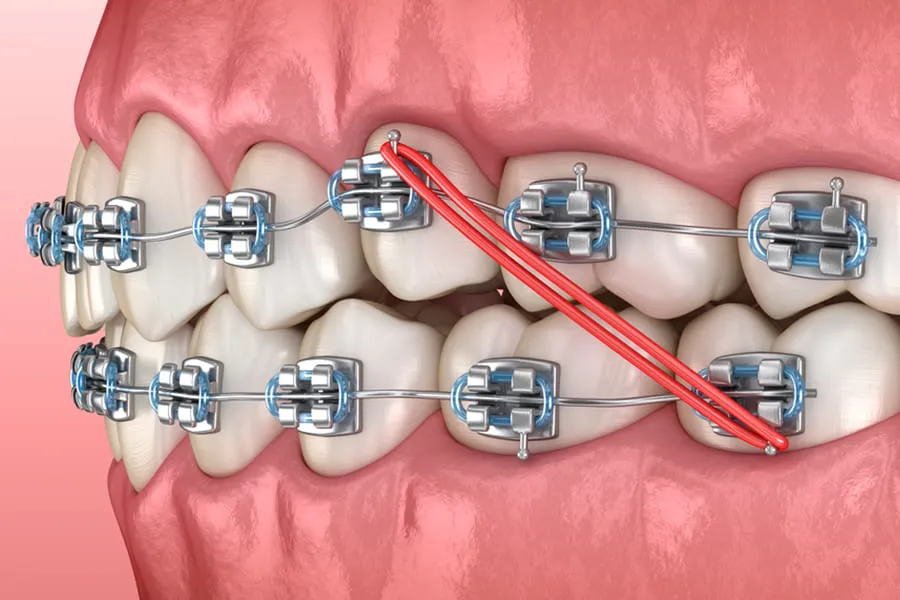 Gomas de brackets ¿Para qué sirven en ortodoncia?