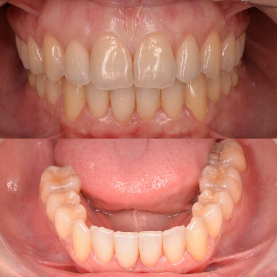 Corrección de la maloclusión dental - apiñamiento en dientes