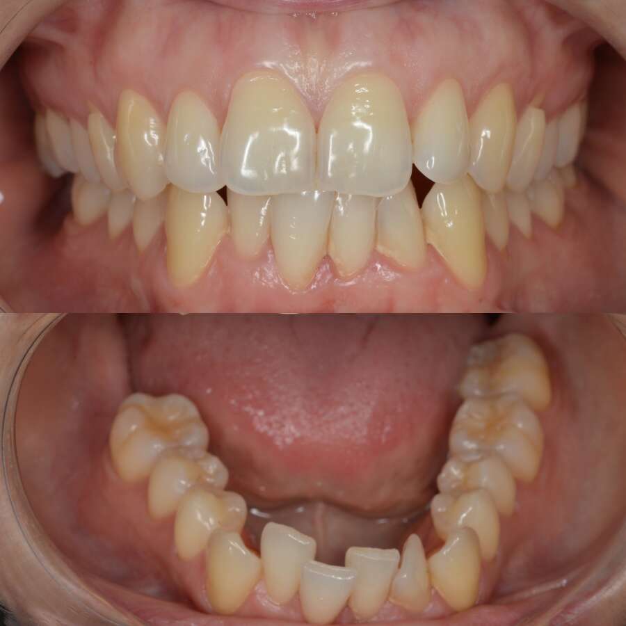 Maloclusión dental - apiñamiento en dientes