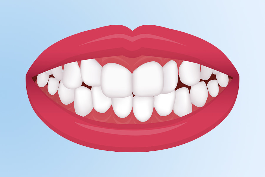 Maloclusión dental: Apiñamiento