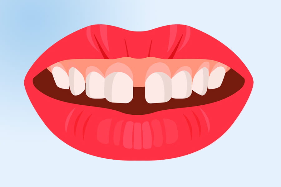 Maloclusión dental: diastema