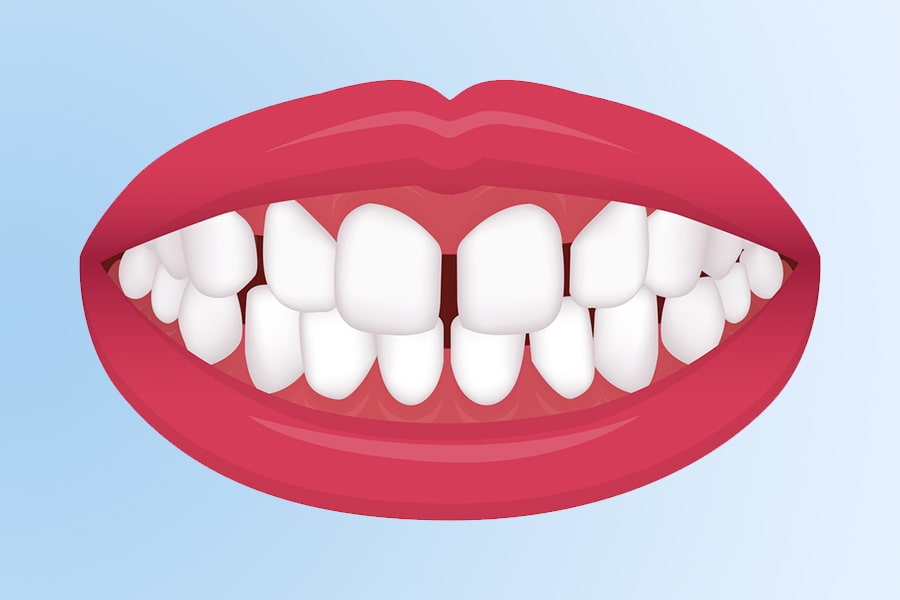 Maloclusión dental: Excesivo espacio dientes