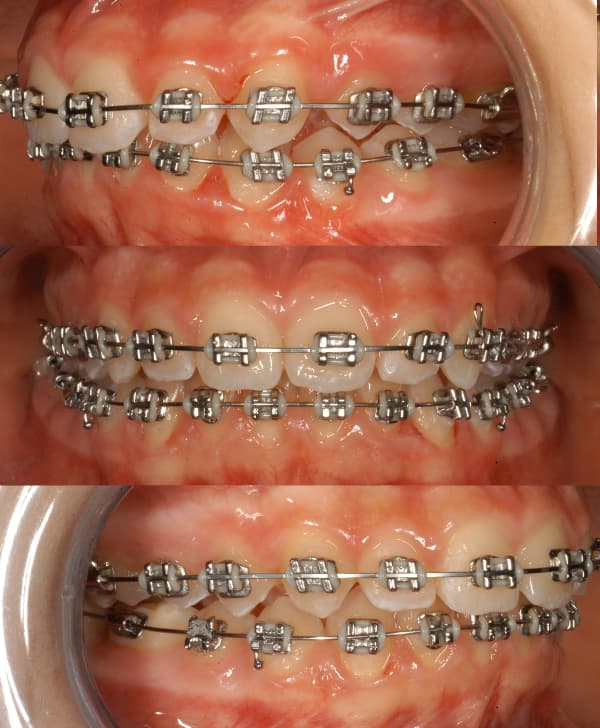 Ortodoncia infantil con brackets metálicos