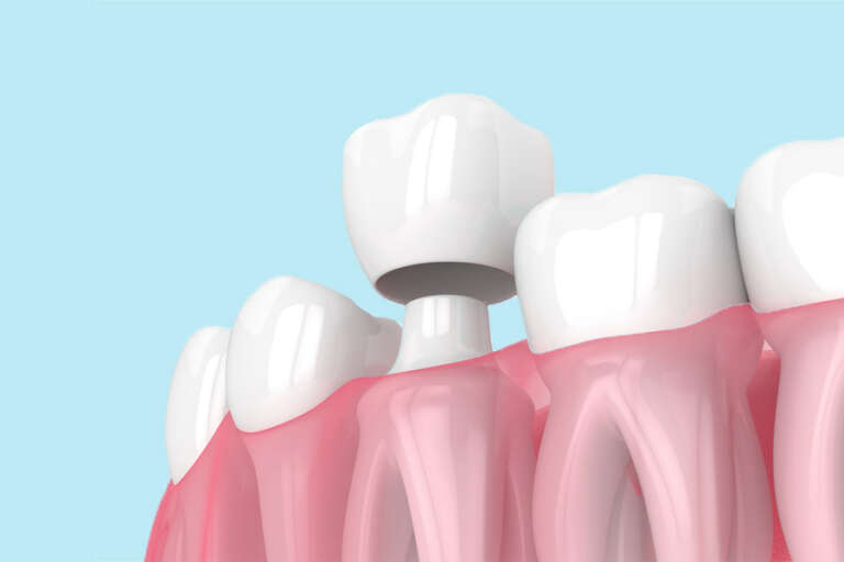 ¿Qué es una corona dental y para qué sirve?