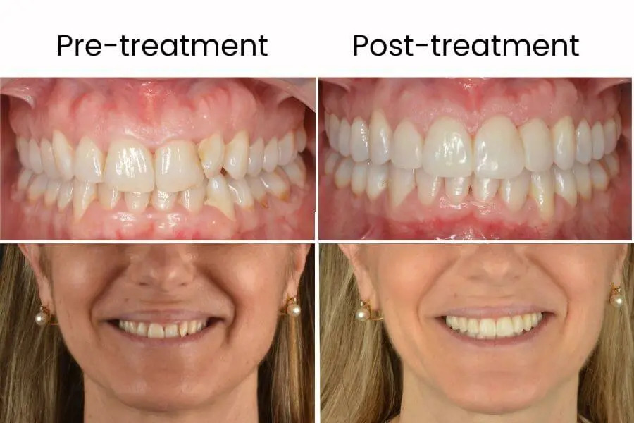 Antes y después de un tratamiento de ortodoncia invisible