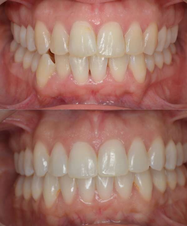 Apiñamiento y desviación mandibular antes y después