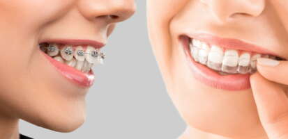 Ortodoncia invisible o Brackets ¿Cuál es mejor?