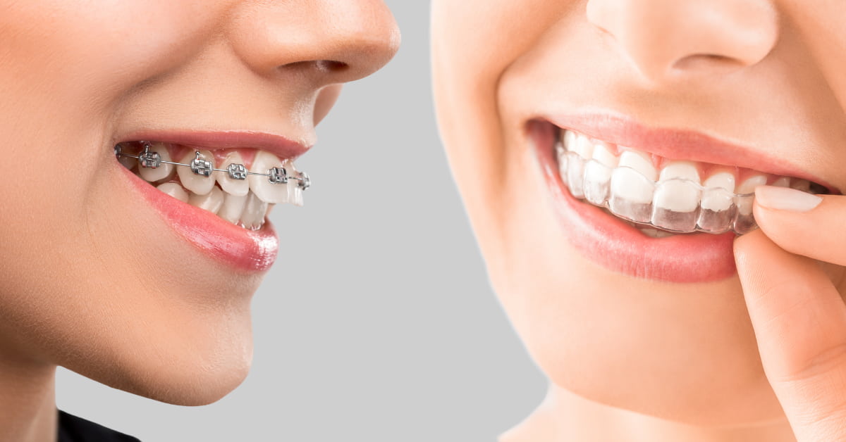 Clínicas Den - ¿Ortodoncia invisible o brackets? 8 diferencias clave para elegir Clínicas Den - ¿Ortodoncia invisible o brackets? 8 diferencias clave para elegir