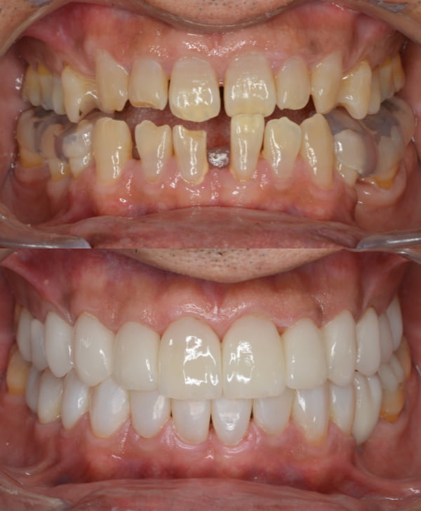 Rehabilitación oral completa antes y después