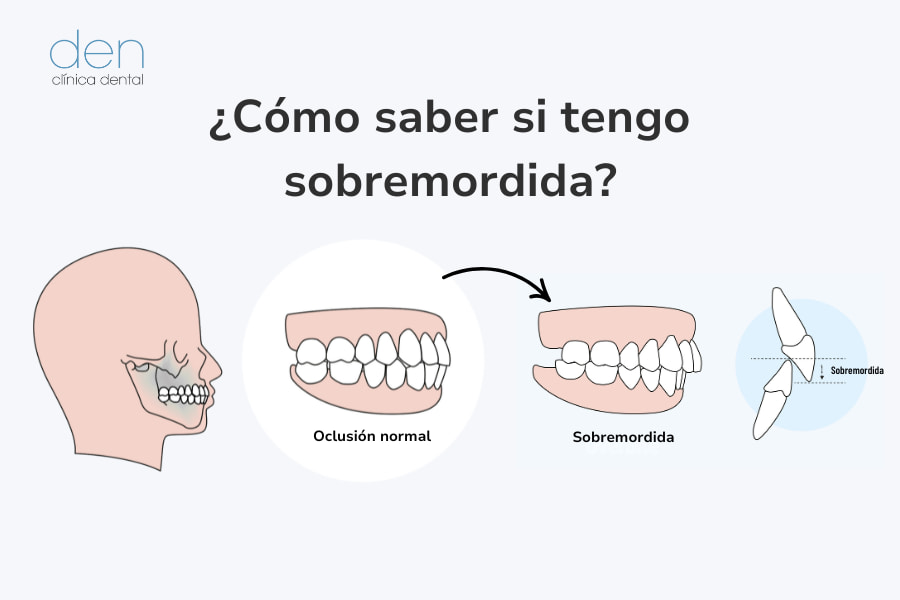 Cómo saber si tengo sobremordida