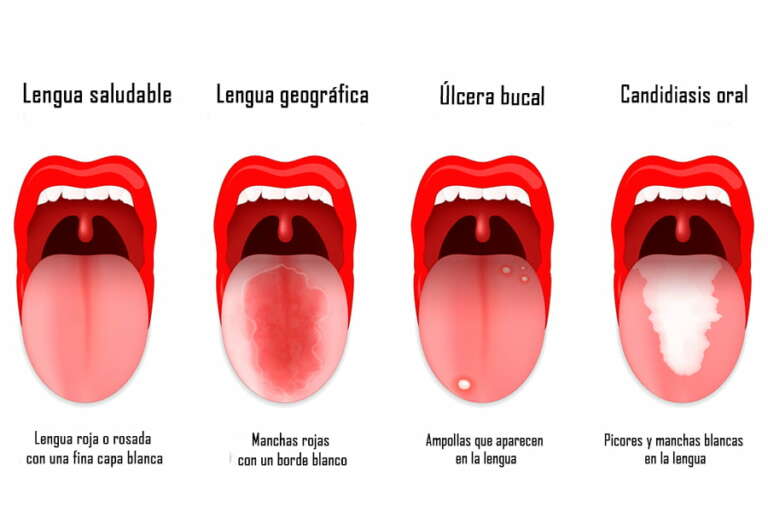 Lengua Geográfica ¿cuáles Son Sus Causas Y Tratamiento 2434