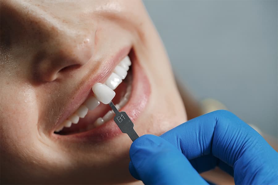 Cómo arreglar un diente roto