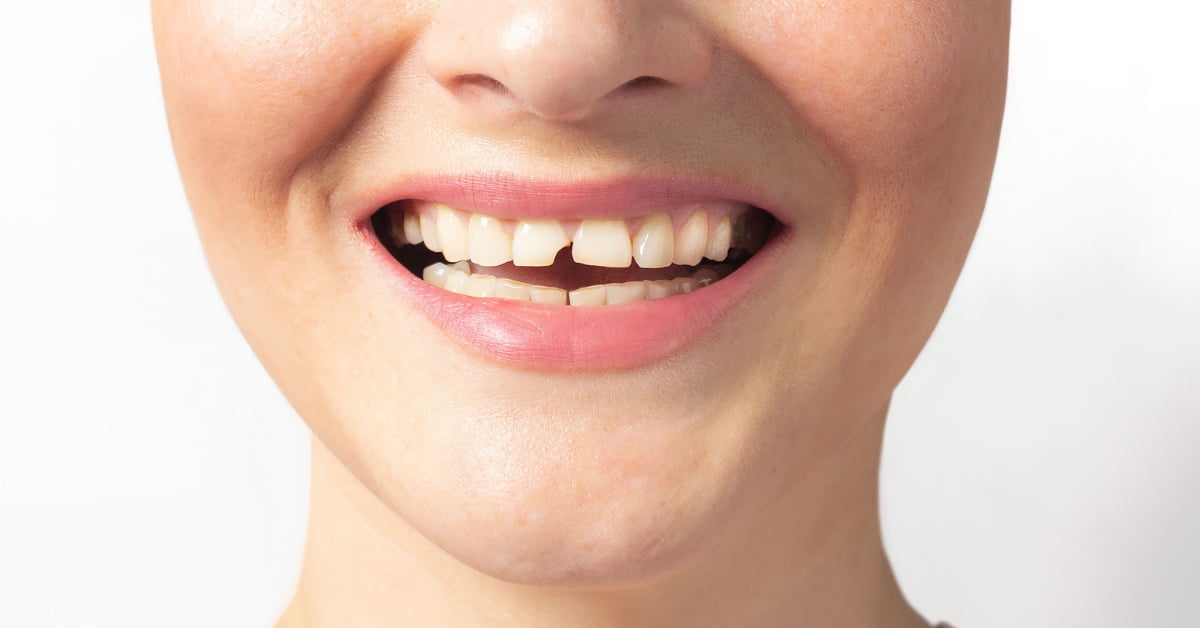 Clínicas Den - ¿Qué hacer si tienes un diente roto y cómo arreglarlo en el dentista?