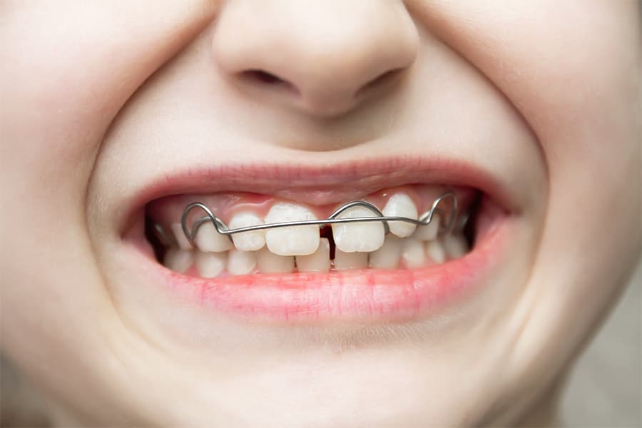 Ortodoncia removible niños