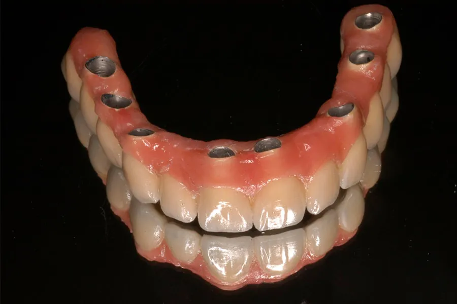Prótesis o dentadura sin paladar ni ganchos
