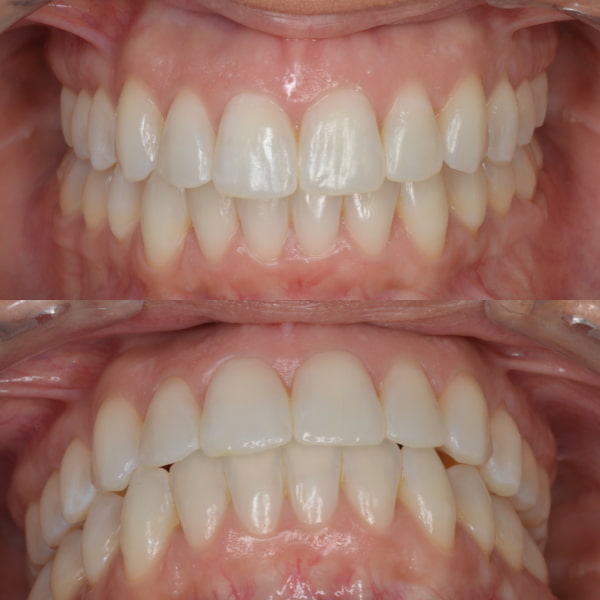 Corregir dientes torcidos